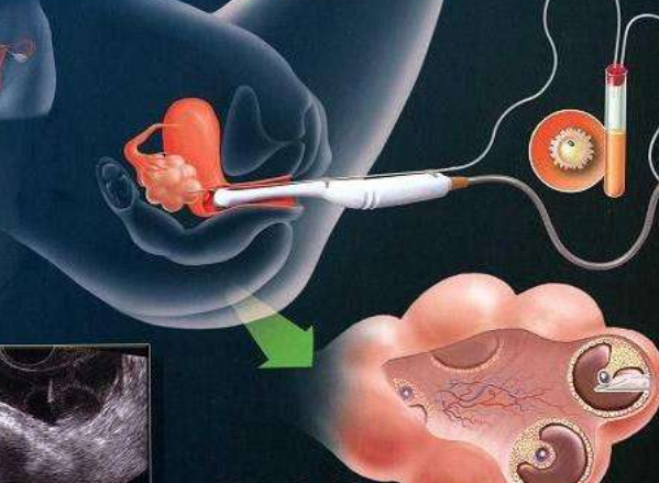 急性呼吸道感染