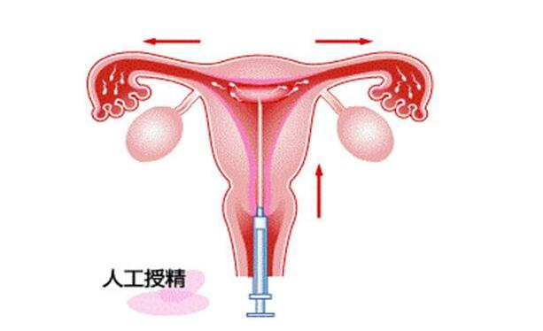 宁波试管婴儿双胞胎咨询